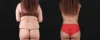 Post Bariatric Surgery (Massive Weight Loss) case #267780 slider thumbnail
