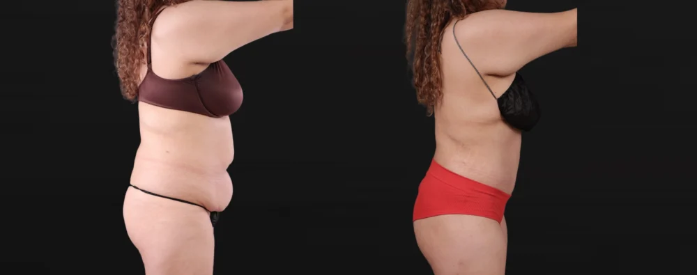 Post Bariatric Surgery (Massive Weight Loss) case #267780