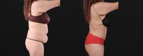 Post Bariatric Surgery (Massive Weight Loss) case #267780