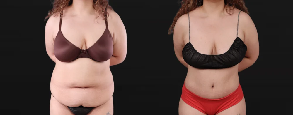Post Bariatric Surgery (Massive Weight Loss) case #267780