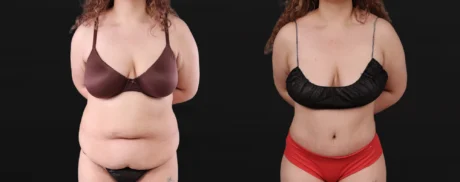Post Bariatric Surgery (Massive Weight Loss) case #267780
