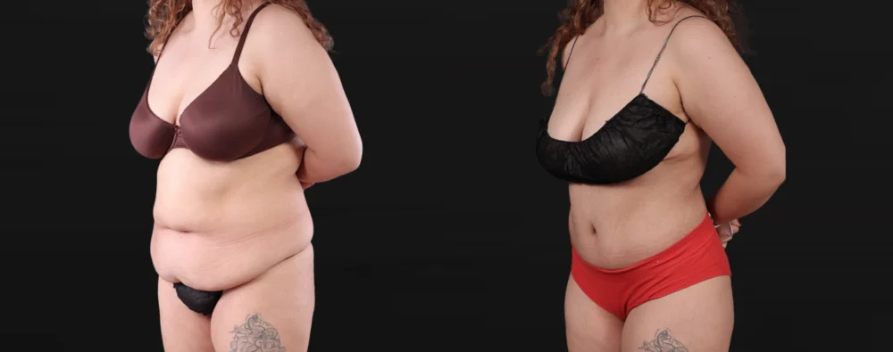 Post Bariatric Surgery (Massive Weight Loss) case #267780