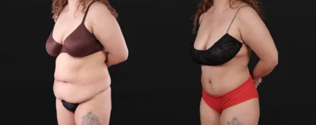 Post Bariatric Surgery (Massive Weight Loss) case #267780