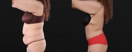 Post Bariatric Surgery (Massive Weight Loss) case #267780