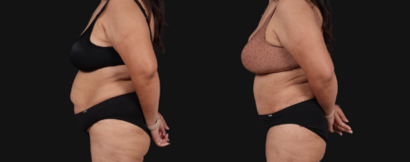 Post Bariatric Surgery (Massive Weight Loss) case #267593