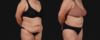 Post Bariatric Surgery (Massive Weight Loss) case #267593 slider thumbnail