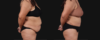 Post Bariatric Surgery (Massive Weight Loss) case #267593 slider thumbnail