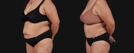Post Bariatric Surgery (Massive Weight Loss) case #267593