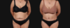 Post Bariatric Surgery (Massive Weight Loss) case #267593 slider thumbnail