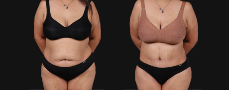 Post Bariatric Surgery (Massive Weight Loss) case #267593
