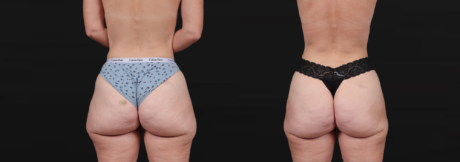 Liposuction case #267813