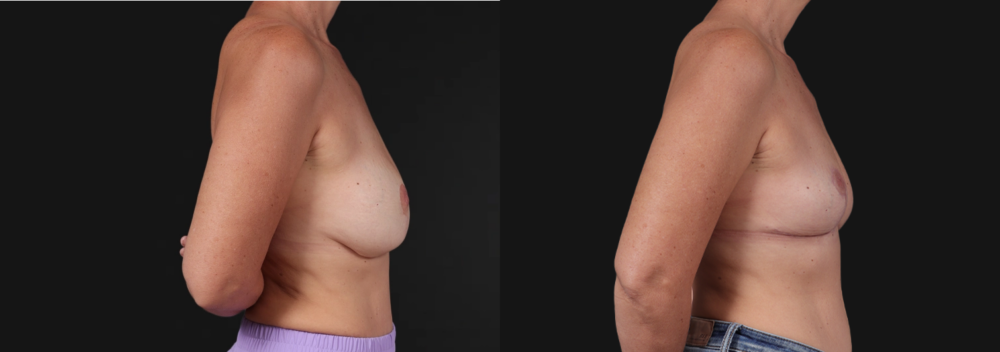 Implant Removal case #268148