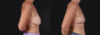 Implant Removal case #268148 slider thumbnail