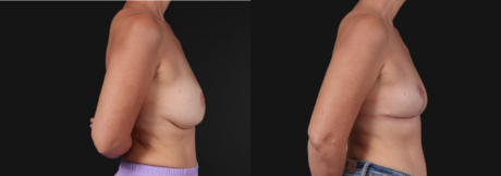 Implant Removal case #268148