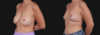 Implant Removal case #268148 slider thumbnail