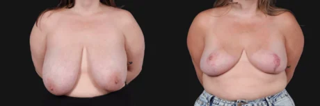 Breast Reduction case #268165