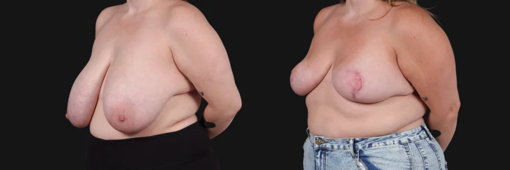 Breast Reduction case #268165