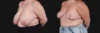 Breast Reduction case #268165 slider thumbnail