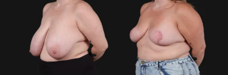 Breast Reduction case #268165