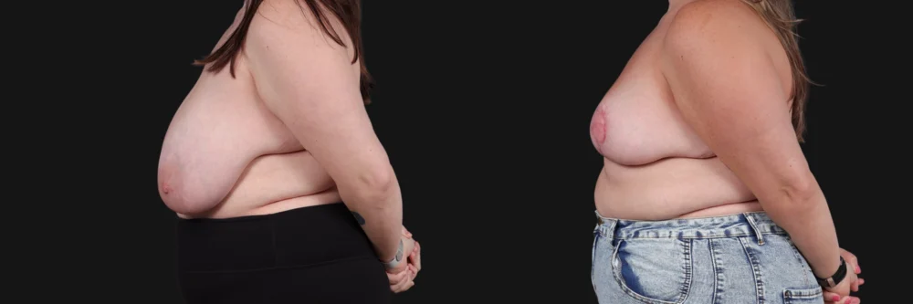 Breast Reduction case #268165