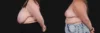 Breast Reduction case #268165 slider thumbnail