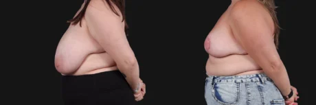Breast Reduction case #268165