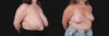 Breast Reduction case #268165 slider thumbnail