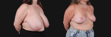 Breast Reduction case #268165