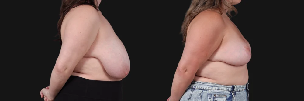 Breast Reduction case #268165