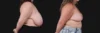 Breast Reduction case #268165 slider thumbnail