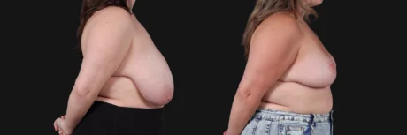 Breast Reduction case #268165